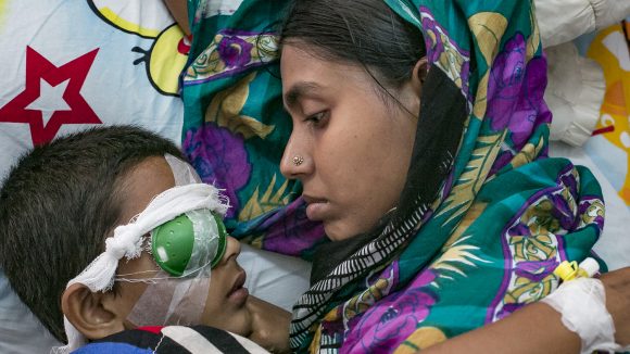 Un mamma sdraiata guarda il suo bambino steso al suo fianco con la benda sull'occhio.