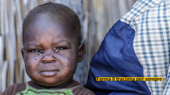 Lubasi ha le mosche in faccia e soffre di tracoma.
