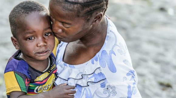 Un bambino con gli occhi gonfi a causa del tracoma abbraccia la sua mamma.