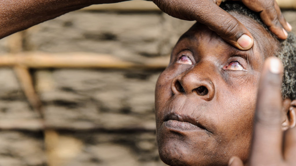 A woman with trachoma has her eyes examined.