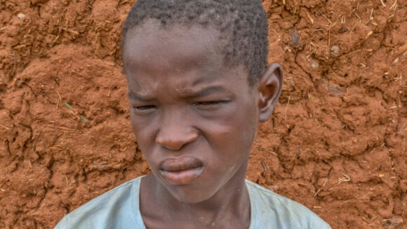 Isa sofferente per tracoma.