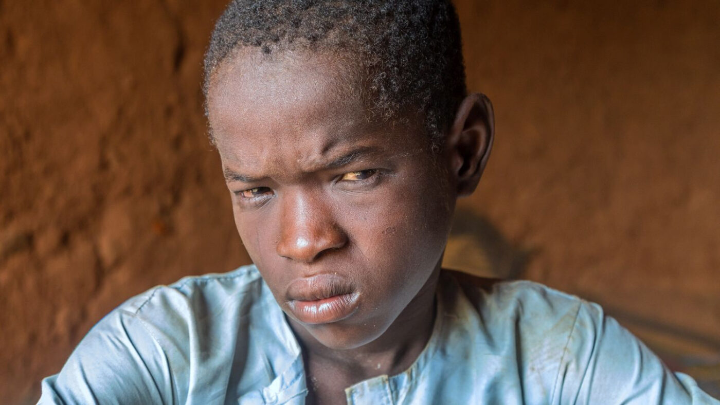 Isa soffre a causa del tracoma.